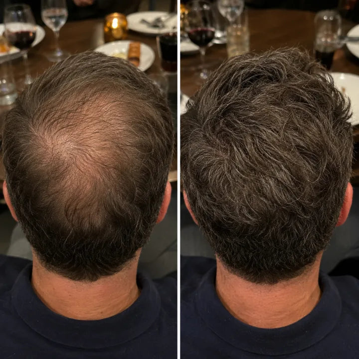 Daniel before and after crown photo after consistent peptide hair serum use
