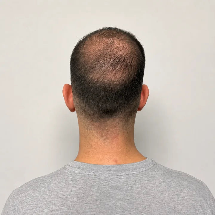 Before starting a scalp routine showing early visible thinning at the crown