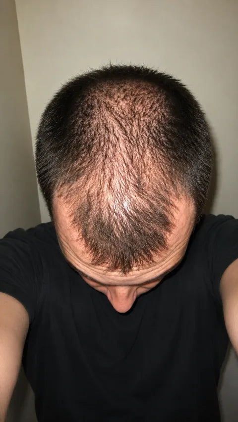 Marcus before using peptide hair serum for thinning at the crown