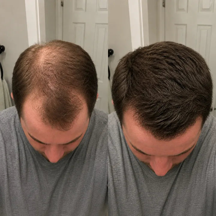 Noah before and after crown photo after staying consistent with peptide hair serum