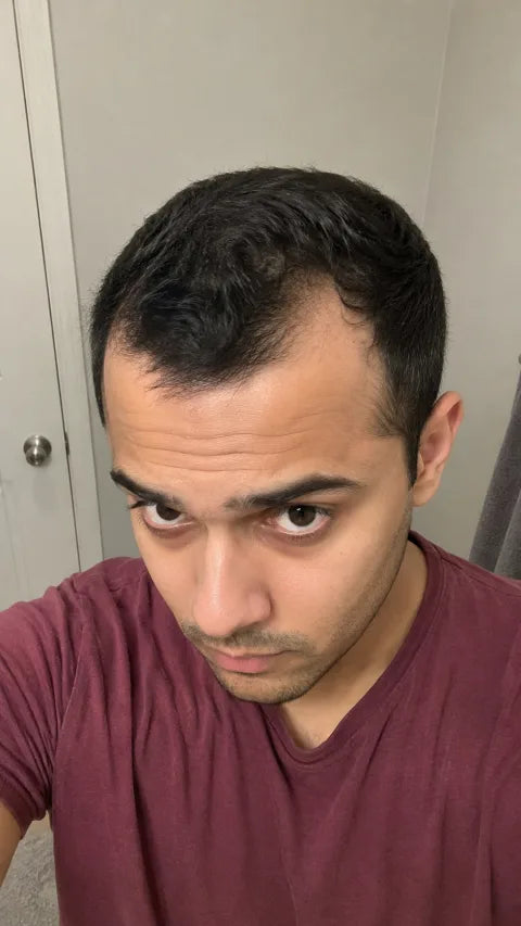 Ryan before using peptide hair serum around the temples